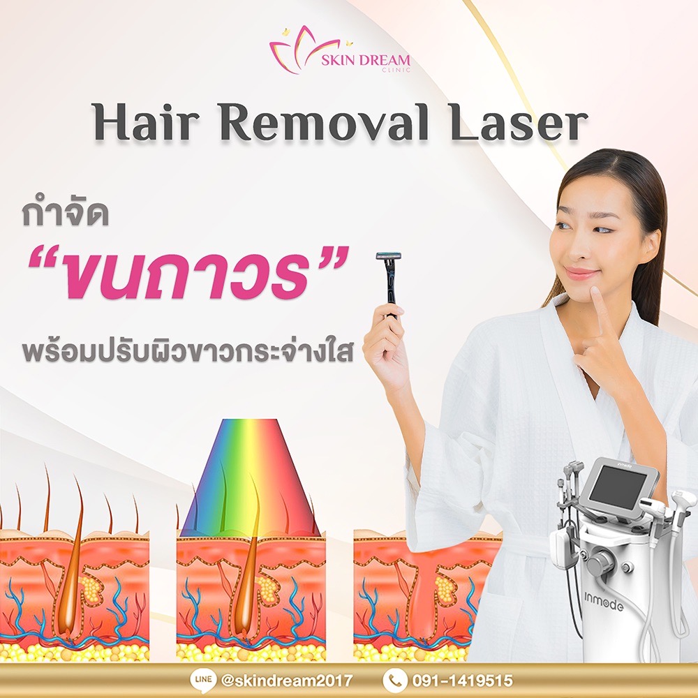 Gemini Hair removal laser